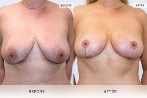 Breast Reduction Patient 02 - 3