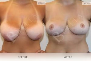 Breast Reduction Patient 20 - 21