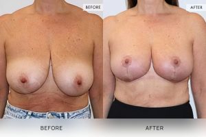 Breast Reduction Patient 03 - 4