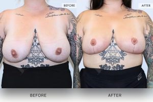 Breast Reduction Patient 05 - 6