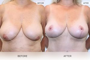 Breast Reduction Patient 07 - 8