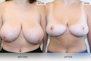 Breast Reduction Patient 08 - 9
