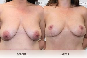 Breast Reduction Patient 09 - 10
