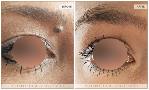 Laser Mole Removal 01 2 Laser Mole Removal 01 - 2