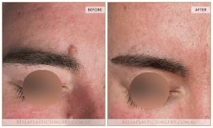 Laser Mole Removal 02 3 Laser Mole Removal 02 - 3