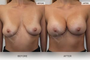 BioLift Patient 01 - 2