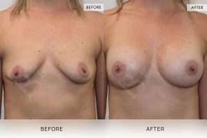 BioLift Patient 10 - 11