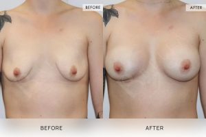 BioLift Patient 11 - 12