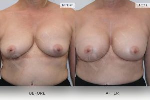 BioLift Patient 12 - 13