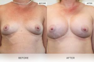 BioLift Patient 13 - 14