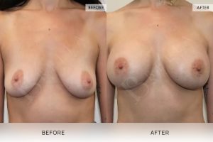 BioLift Patient 14 - 15