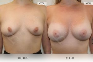 BioLift Patient 15 - 16