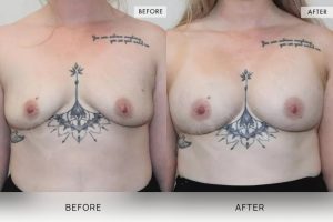 BioLift Patient 16 - 17