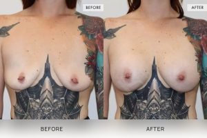 BioLift Patient 17 - 18