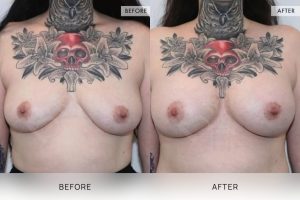BioLift Patient 18 - 19