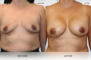BioLift Patient 19 - 20