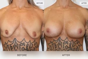 BioLift Patient 02 - 3