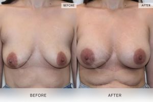 BioLift Patient 20 - 21