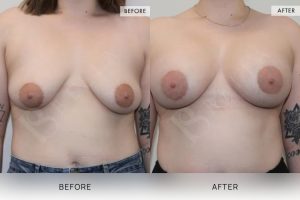 BioLift Patient 21 - 22