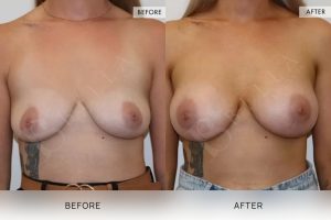 BioLift Patient 22 - 23