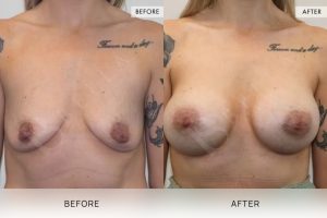 BioLift Patient 23 - 24