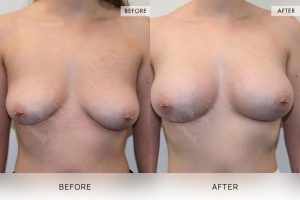 BioLift Patient 03 - 4