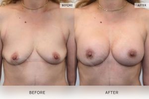 BioLift Patient 04 - 5