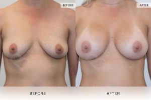 BioLift Patient 06 - 7