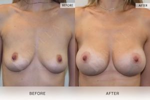BioLift Patient 07 - 8