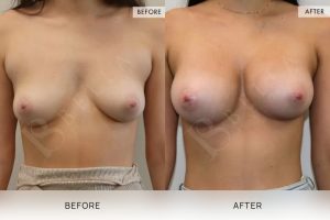 BioLift Patient 08 - 9
