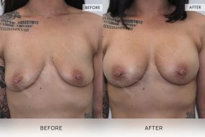 BioLift Patient 09 - 10