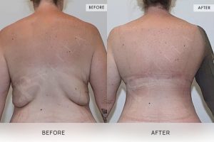 Bra Lipectomy Patient 01 - 2