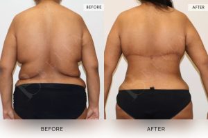 Bra Lipectomy Patient 10 - 11