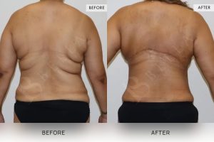 Bra Lipectomy Patient 11 - 12