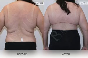 Bra Lipectomy Patient 12 - 13