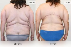 Bra Lipectomy Patient 13 - 14