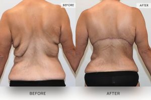 Bra Lipectomy Patient 14 - 15
