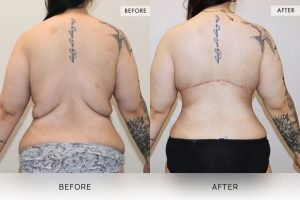 Bra Lipectomy Patient 15 - 16