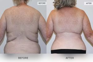 Bra Lipectomy Patient 04 - 5