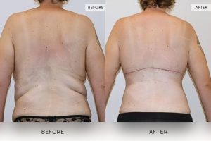 Bra Lipectomy Patient 05 - 6