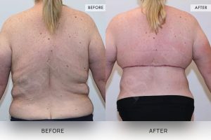 Bra Lipectomy Patient 06 - 7