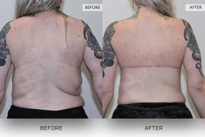 Bra Lipectomy Patient 07 - 8