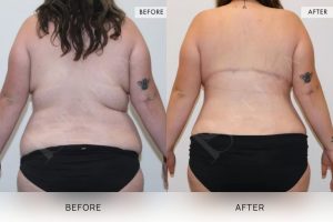 Bra Lipectomy Patient 09 - 10