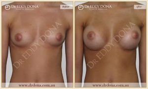 Breast Augmentation 33 - 32