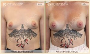 Breast Augmentation 35 - 34