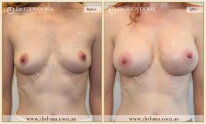 Breast Augmentation 31 - 30