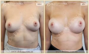Breast Augmentation 32 - 31