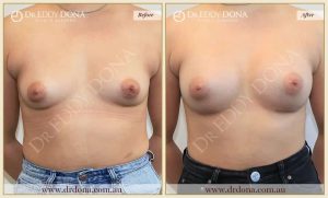 Breast Augmentation 36 - 35