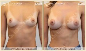 Breast Augmentation 38 - 37