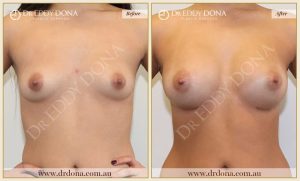 Breast Augmentation 39 - 38